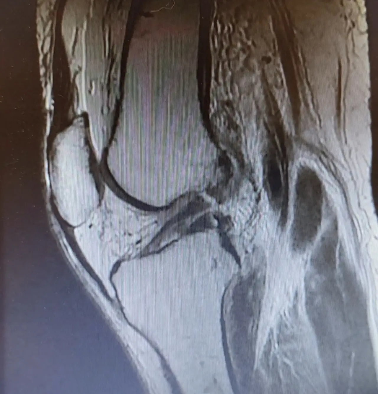 Resonancia magnética sagital de rodilla revisada antes de una artroscopia