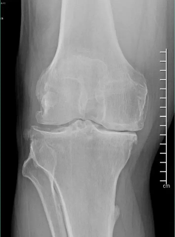 Radiografía frontal de una rodilla con artrosis avanzada