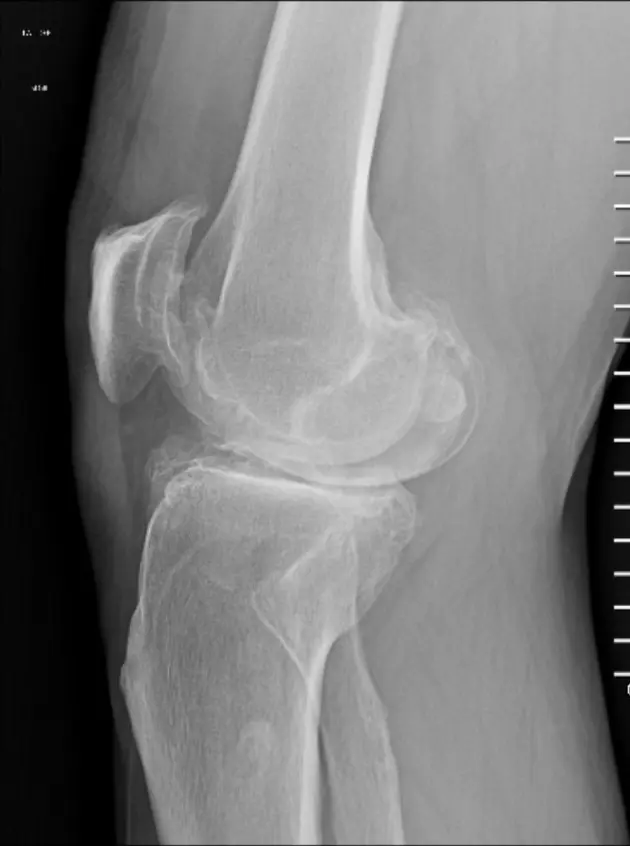 Radiografía lateral de una rodilla con artrosis avanzada