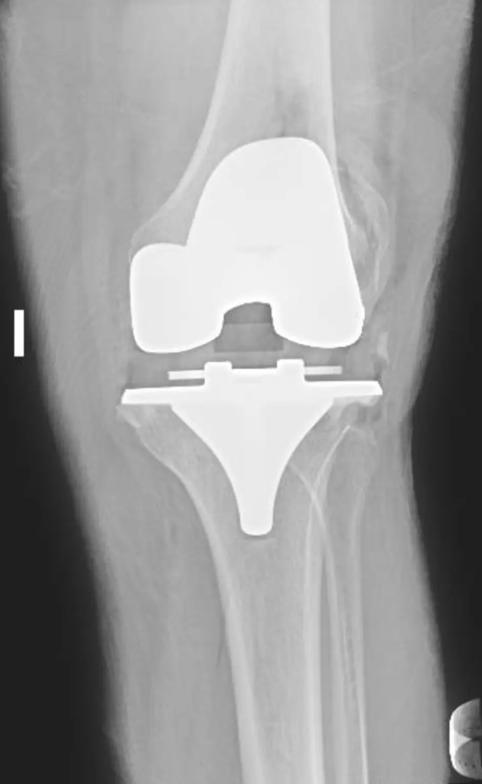 Radiografía frontal después de una prótesis total de rodilla