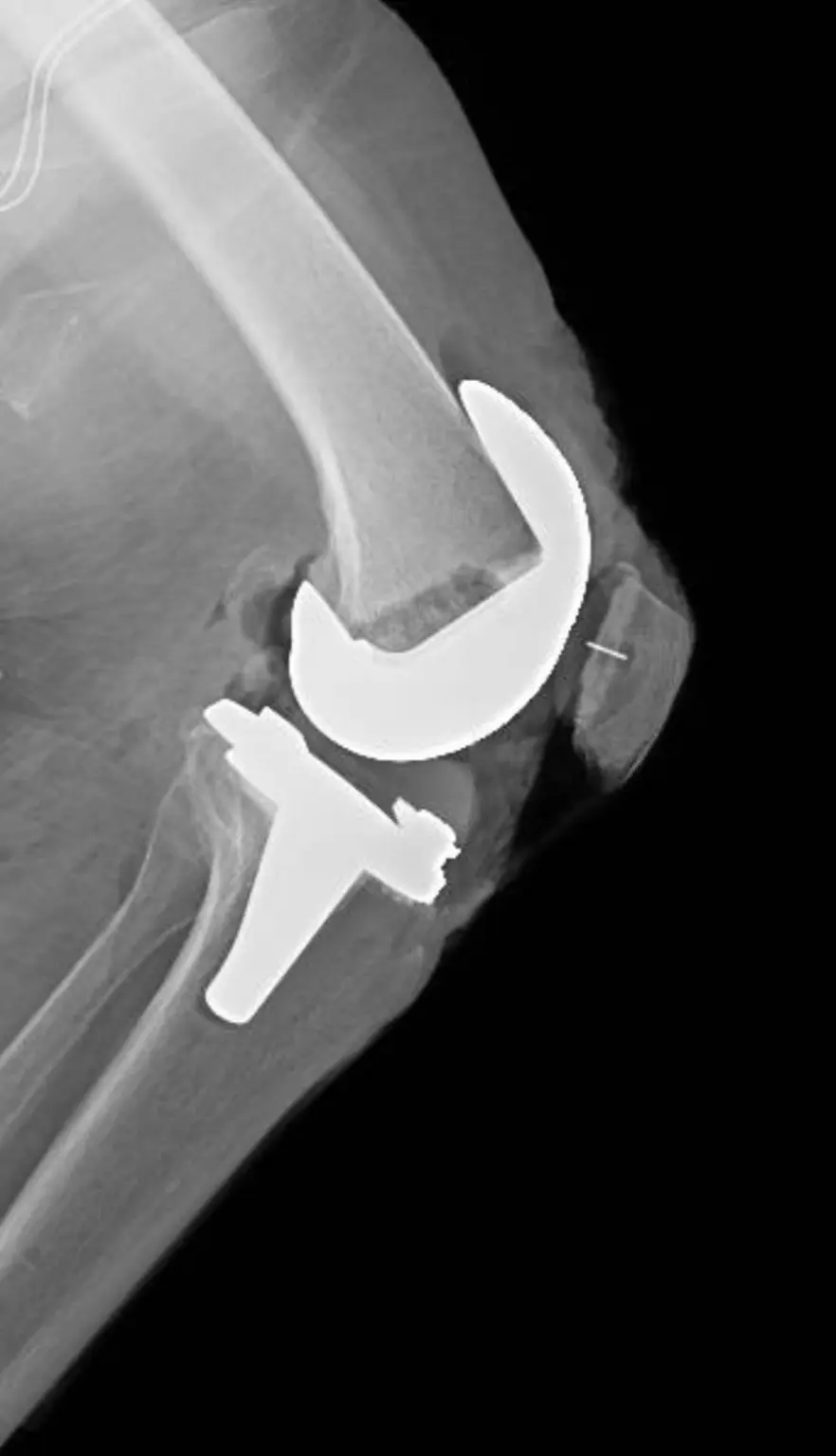 Radiografía lateral de una prótesis total de rodilla