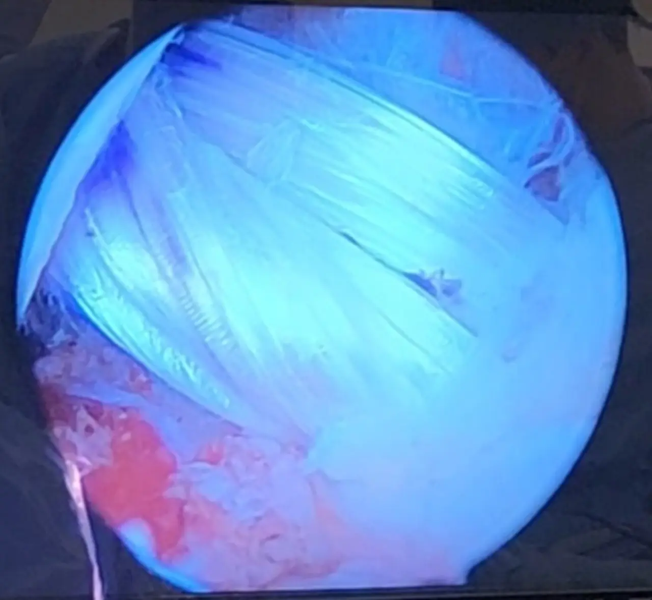 Imagen artroscópica del injerto durante una reconstrucción del ligamento cruzado anterior