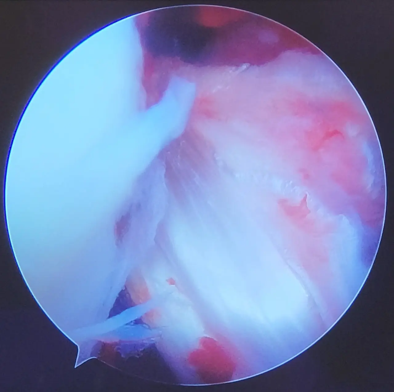 Vista artroscópica durante una reconstrucción del ligamento cruzado anterior