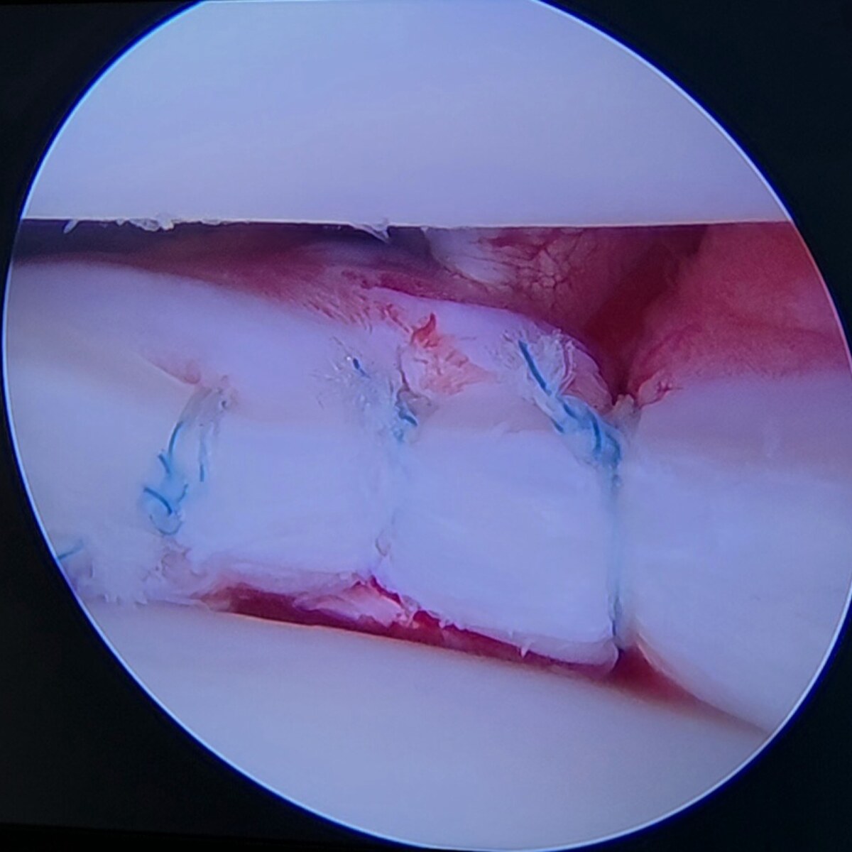 Imagen artroscópica de una reparación de menisco lateral